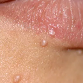 Wypryski skórne koło ust mięczak zakaźny