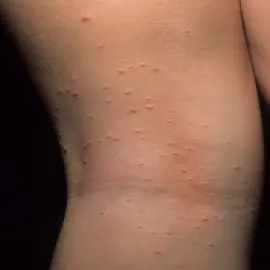 Wypryski skórne na nodze mięczak zakaźny