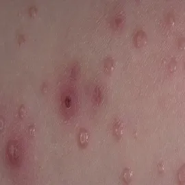 Wysypka czerwone kropki mięczak zakaźny