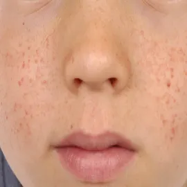 Wysypka guzki na policzkach gruczolak łojowy