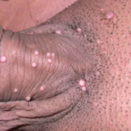 Wysypka na genitaliach mięczak zakaźny