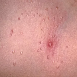 Wysypka na skórze w postaci guzków