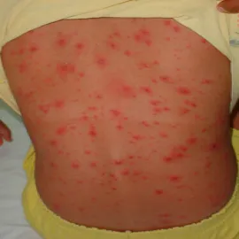 Wysypka ospa u dziecka