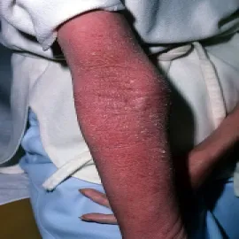 Złuszczające zapalenie skóry 