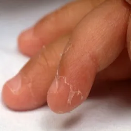  Złuszczanie się skóry choroba Kawasakiego