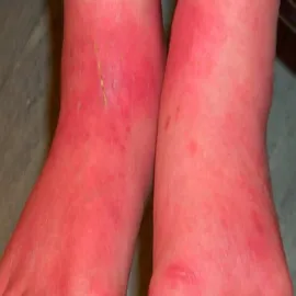 Zaczerwienienie skóry na nogach choroba Mitchella