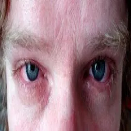 Zaczerwienione oczy rzeżączka