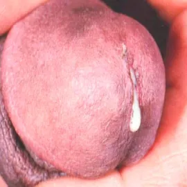 Zapalenie cewki moczowej u mężczyzny z wyraźną lub lekko mętną wydzieliną