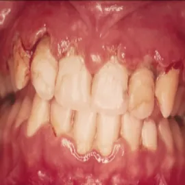 zapalenie dziąseł Vincenta