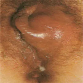 Zdjęcia chorób wenerycznych u kobiet rzeżączka