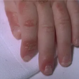 Zespół Brandta zdjęcie