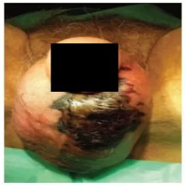 Zgorzel fourniera choroba moszny