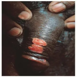 Ziarniniak pachwinowy donowanoza