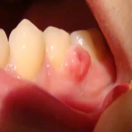 Zmiany chorobowe na dziąsłach nadziąślak 