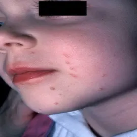 Zmiany mięczakowe na twarzy