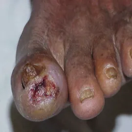 Zmiany na palcach u nóg gangrena właściwa