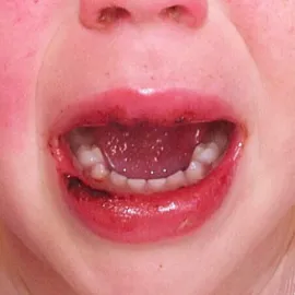 Zmiany na wargach u dziecka choroba Kawasaki