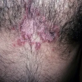 Zmiany skórne klatka piersiowa choroba Haileya-Haileya 