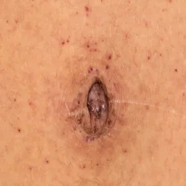 Zmiany skórne koło pępka choroba Fabry'ego