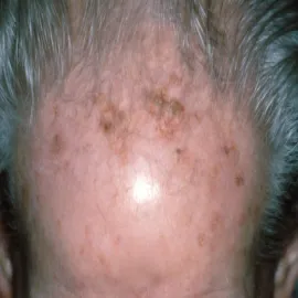 Zmiany skórne na czole