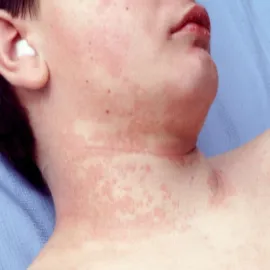 Zmiany skórne na szyi choroba Kawasakiego 
