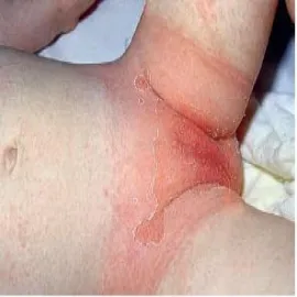 Zmiany skórne okolice intymne u dziecka choroba Kawasakiego 