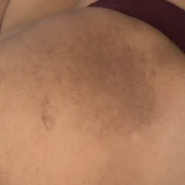 amyloidozy skóry na nodze