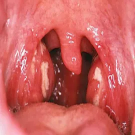 angina wrzodziejąco-błoniasta