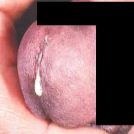 biała wydzielina z cewki moczowej u mężczyzn