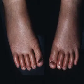 bolesny rumień kończyn dolnych