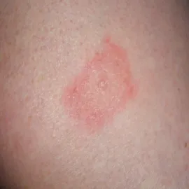 borelioza objawy skórne zdjęcia