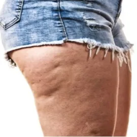 cellulit tłuszczowy