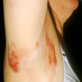 choroba haileya-haileya zdjęcia