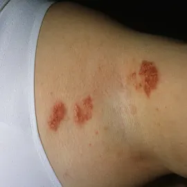 Choroba Haileya-Haileya