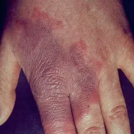 choroby odzwierzęce od bydła różyca 