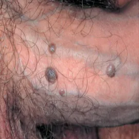 choroby penisa grudkowatość bowenoidalna 