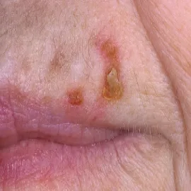 choroby skóry rogowacenie słoneczne na twarzy