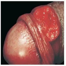 choroby weneryczne u mężczyzn ziarniniak pachwinowy 