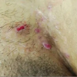 czyraki w okolicach intymnych