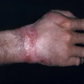 drożdżyca amerykańska 