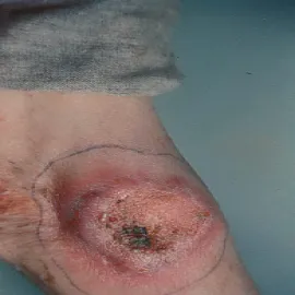 drożdżyca północnoamerykańska