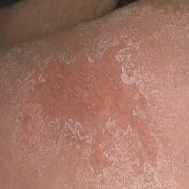 exfoliative dermatitis