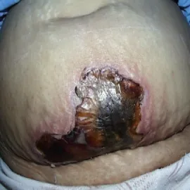 gangrena zmiany skórne