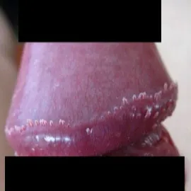 grudki perliste na żołędziu