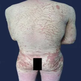 jak wygląda świerzb norweski