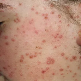 jak wygląda ospa zdjęcia