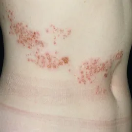 jak wygląda półpasiec zdjęcia