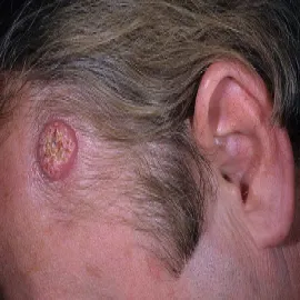 keratoacanthoma zdjęcie