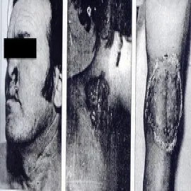 kiła owrzodzenie pierwotne