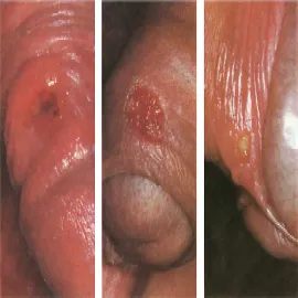  Kiła pierwotna twarde wrzody 